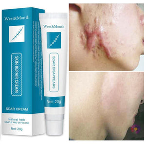 Herbal Scar Removal Cream Skin Care