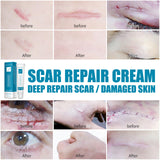 Herbal Scar Removal Cream Skin Care